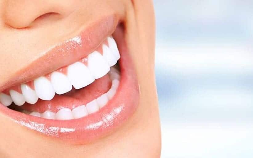 Carillas dentales de resina para mejorar estética dental en clínica Ray Concept